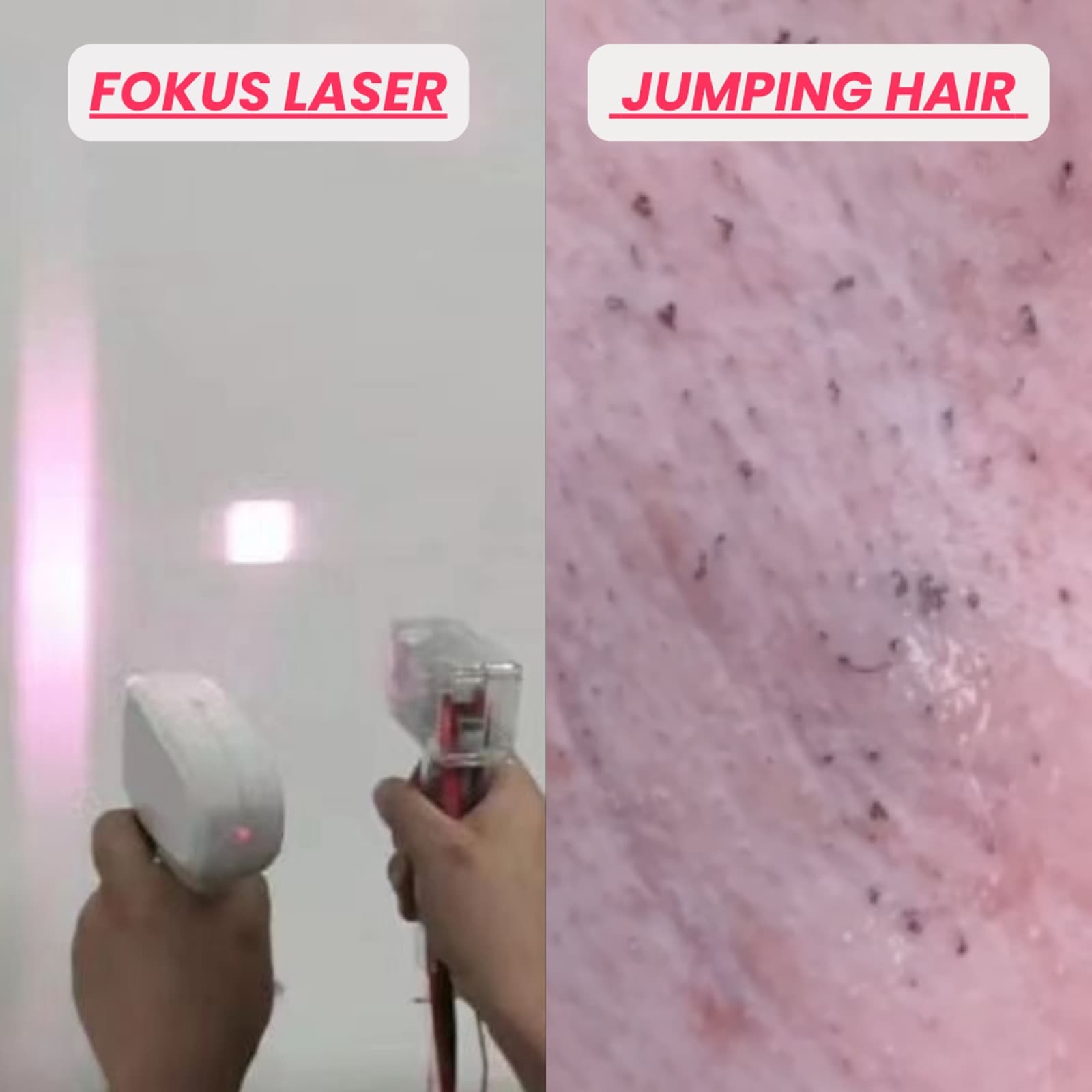 Zwei Hände halten Lasergeräte, die rotes Licht projizieren, daneben eine Nahaufnahme von Haut mit feinen Haaren.